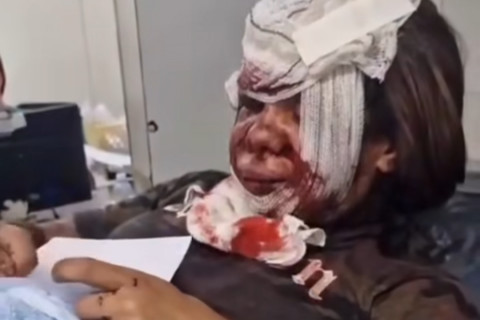 Mulher fica com rosto desfigurado após ser agredida com 60 socos pelo próprio namorado.